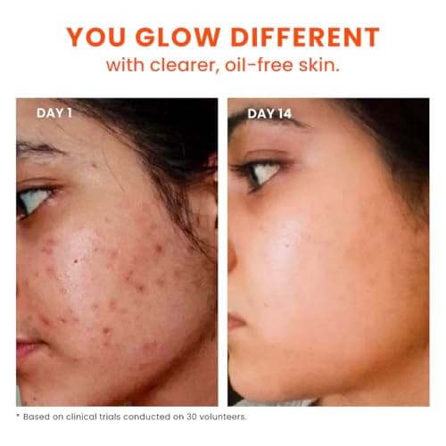 Foxtale 12% Niacinamide Face Serum with Azelaic Acid for Brightening & Oil Control | Reduces Acne, Blemishes & Acne Marks | Brightens & Smoothens Skin | Face Serum for Women & Men | 30 ml